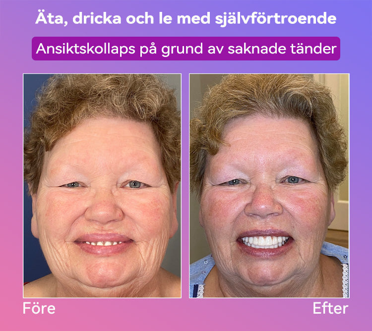 𝐉𝐚𝐬𝐬𝐞𝐞𝐦® Senaste Premium Komfort Tandproteser🎁 (Högkvalitativa Tandproteser, Bekväma att Bära - Begränsad Tid 70% Rabatt)