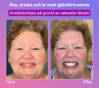 𝐉𝐚𝐬𝐬𝐞𝐞𝐦® Senaste Premium Komfort Tandproteser🎁 (Högkvalitativa Tandproteser, Bekväma att Bära - Begränsad Tid 70% Rabatt)