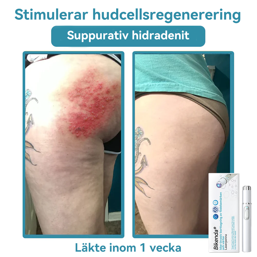 𝐁𝐢𝐤𝐞𝐧𝐝𝐚® medicinsk laserpenna 💕 (använder koldioxidlaserteknologi – effektiv för att ta bort födelsemärken, vårtor, hudflikar, pigmentfläckar och andra hudfel)🏆