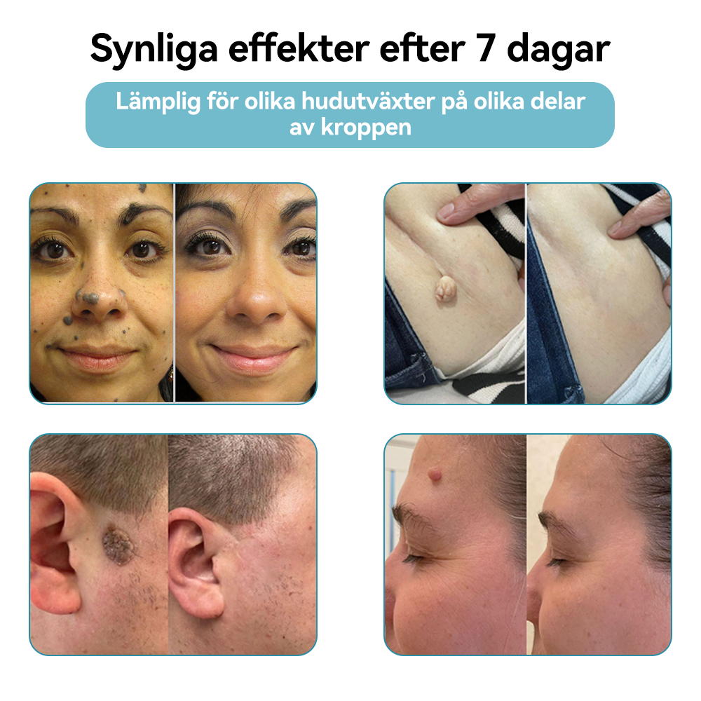 Bikenda® laserpenna🎁 (med CO₂-laserteknik – effektiv för att ta bort födelsemärken, vårtor, hudflikar, pigmentfläckar och andra hudproblem)