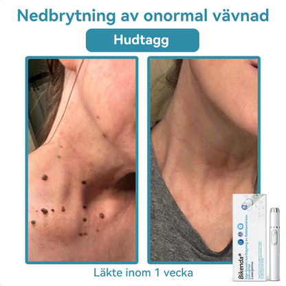 Bikenda® laserpenna🎁 (med CO₂-laserteknik – effektiv för att ta bort födelsemärken, vårtor, hudflikar, pigmentfläckar och andra hudproblem)