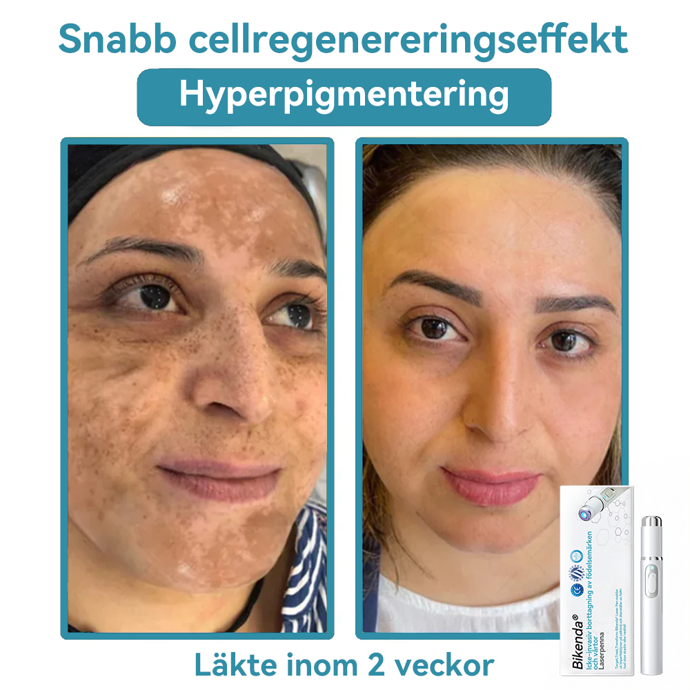Bikenda® laserpenna🎉 (med CO₂-laserteknik – effektiv för att ta bort födelsemärken, vårtor, hudflikar, pigmentfläckar och andra hudproblem)🏆