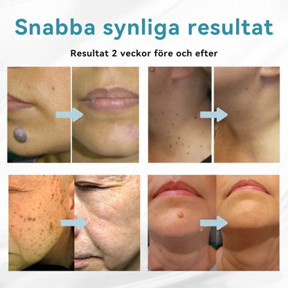 𝐁𝐢𝐤𝐞𝐧𝐝𝐚® medicinsk laserpenna 💕 (använder koldioxidlaserteknologi – effektiv för att ta bort födelsemärken, vårtor, hudflikar, pigmentfläckar och andra hudfel)🏆