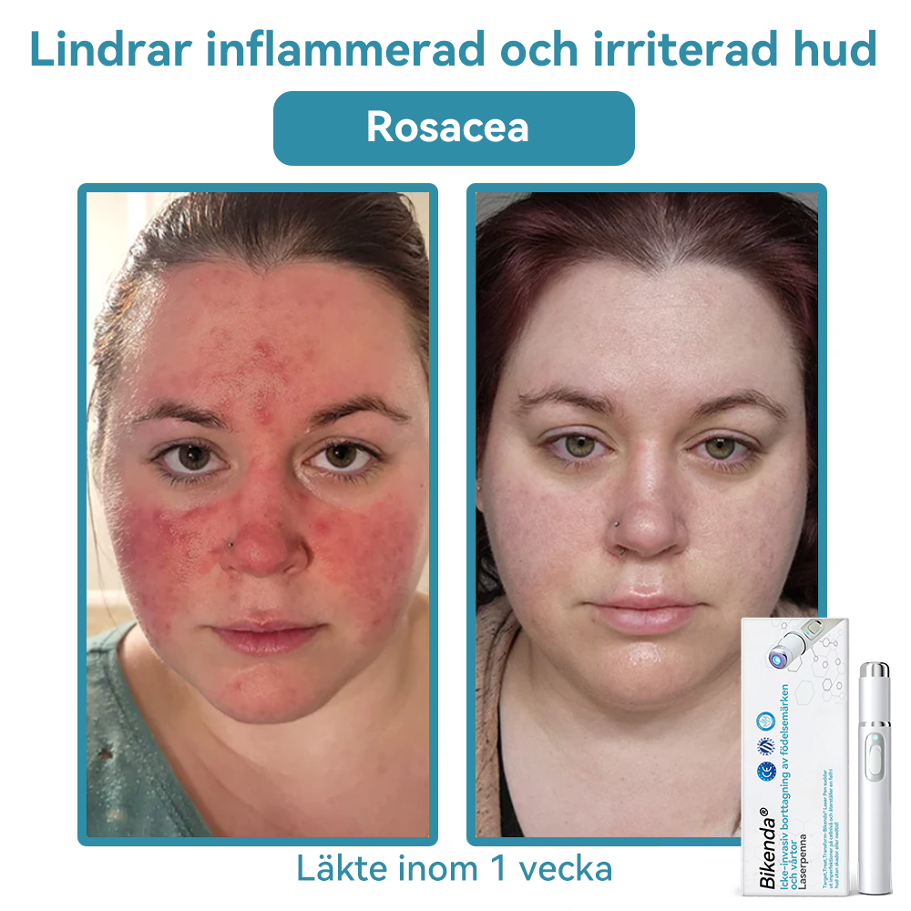 1 st – (Icke-invasiv professionell borttagning av födelsemärken och vårtor)